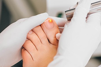 Understanding Laser Treatment for Fungal Toenails