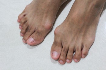 Do Bunion Correctors Work?