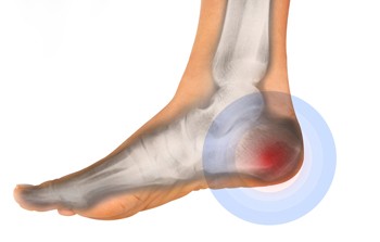 Reasons for Heel Pain After Running