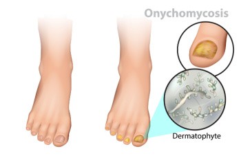 Symptoms and Causes of Fungal Toenails