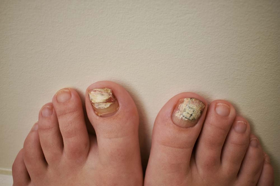 Can Toenail Fungus Spread Through Nail Polish 